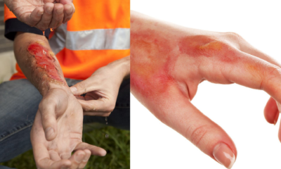 Everything You Need to Know About Second-Degree Burns
