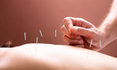 A woman having needle therapy that promotes overall wellness
