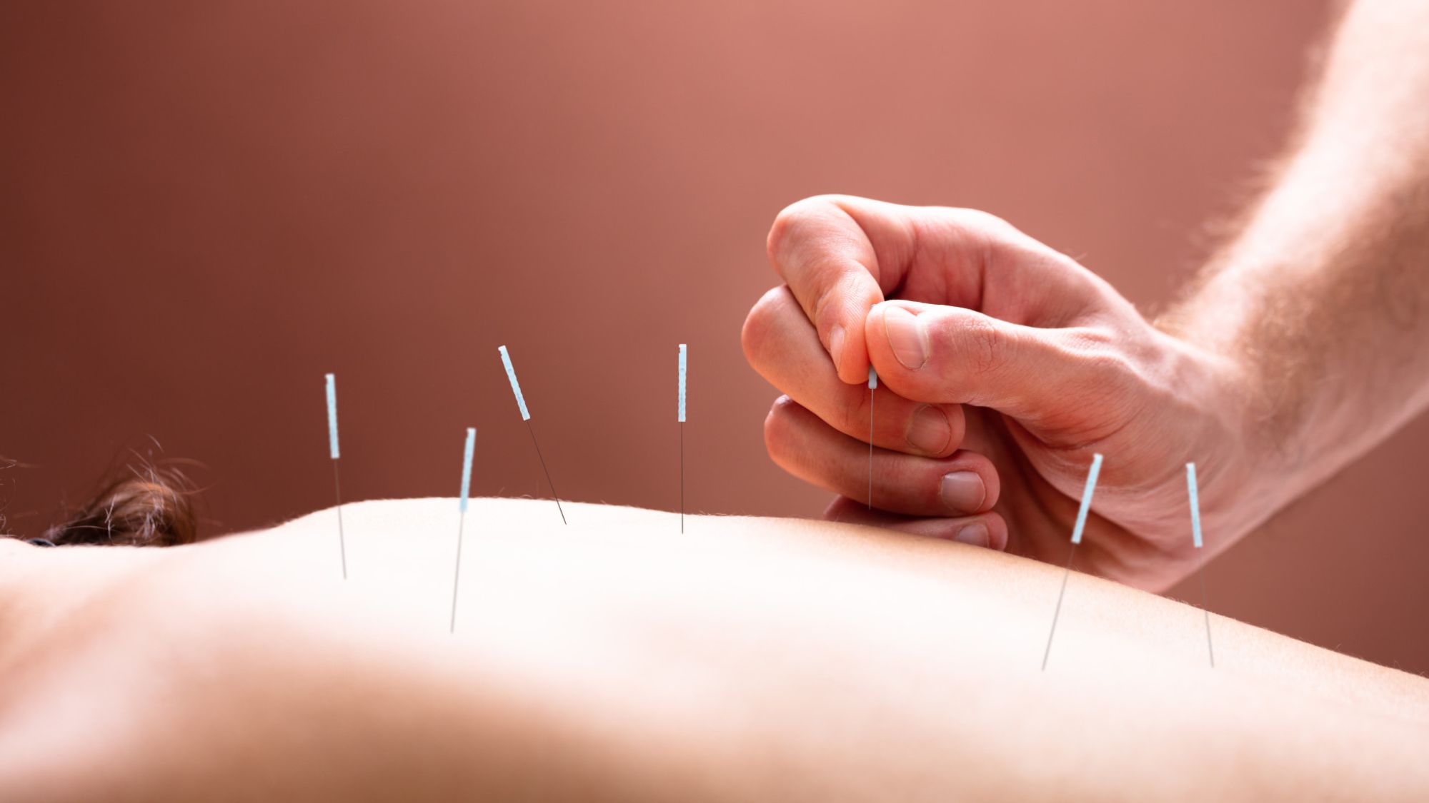 A woman having needle therapy that promotes overall wellness
